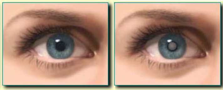 Katarakt əməliyyatından öncə bilməli olduğunuz məqamlar.