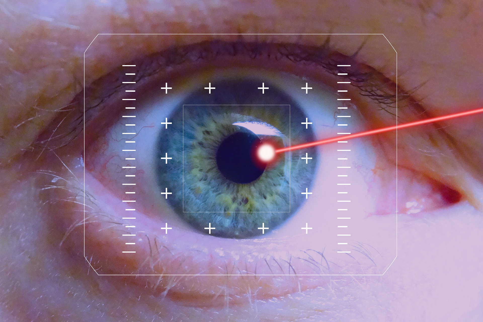 LASIK əməliyyatı kimlər üçün uyğundur?